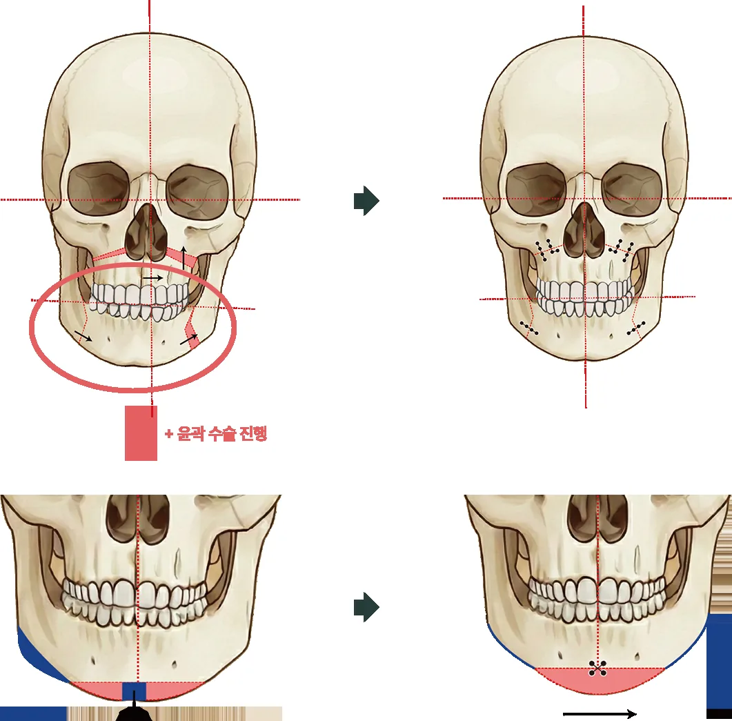 안면비대칭 수술 방법 모식도