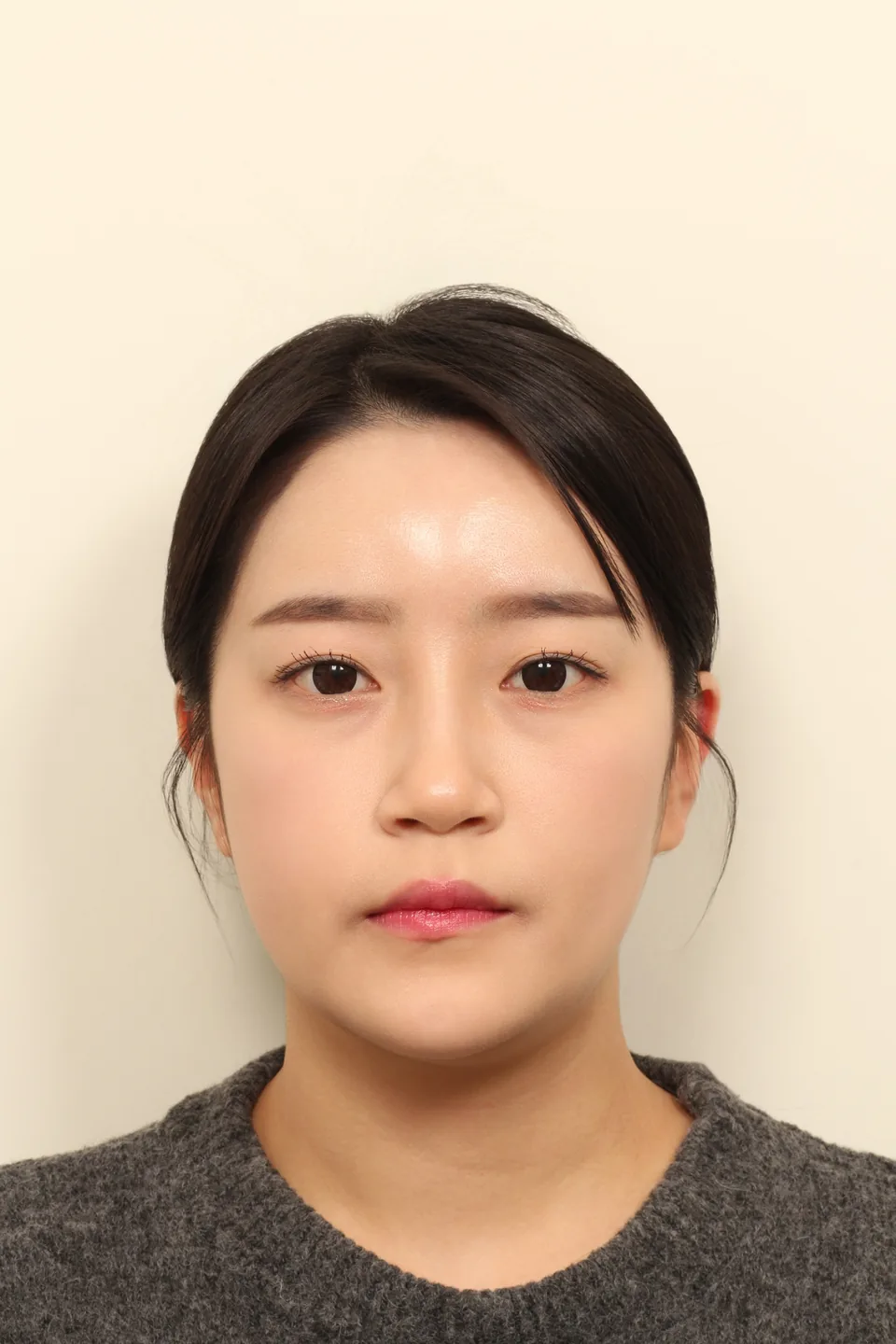 안면비대칭 수술 후 9개월 정면