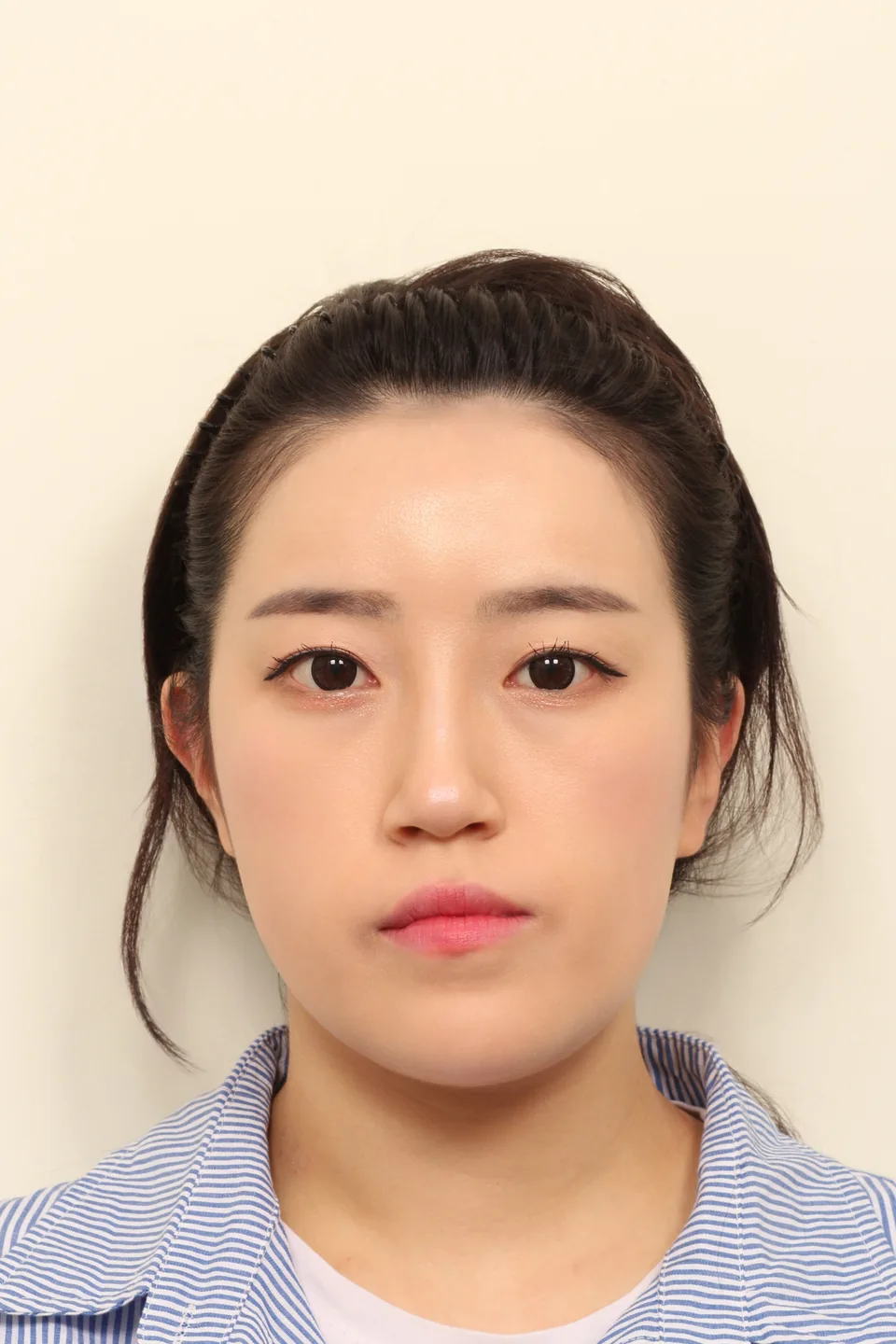 안면비대칭 수술 전 정면