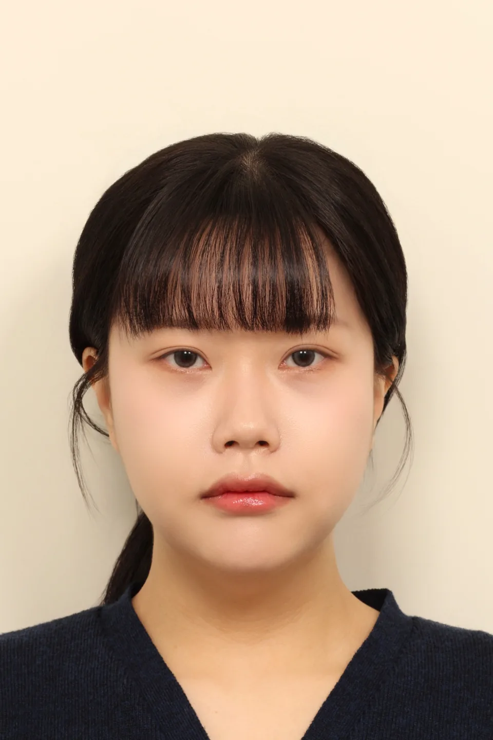 윤곽 3종 수술 후 1년 정면
