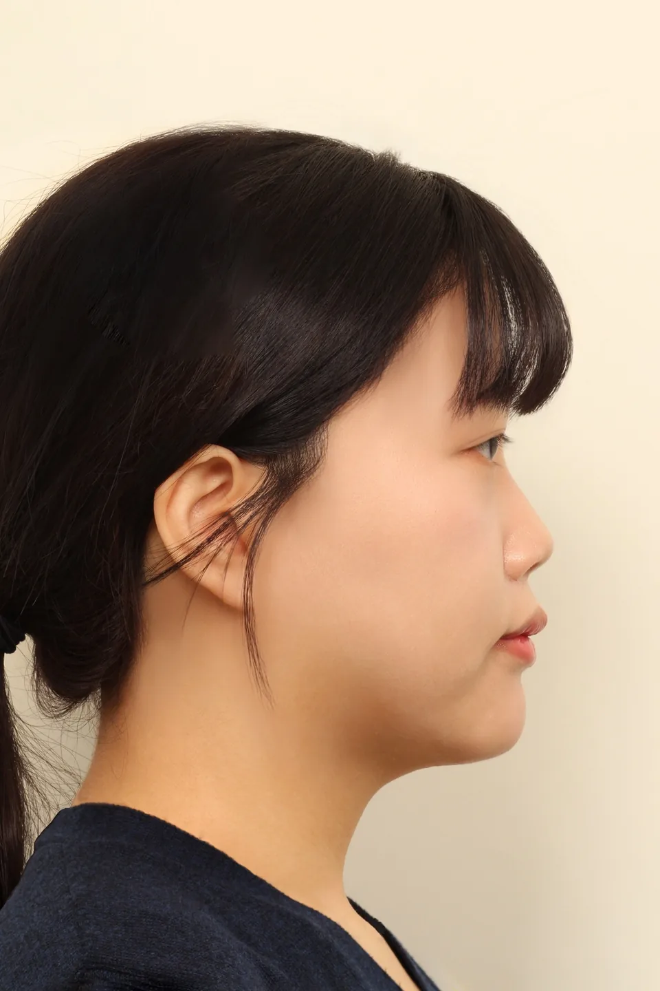 윤곽 3종 수술 후 1년 측면