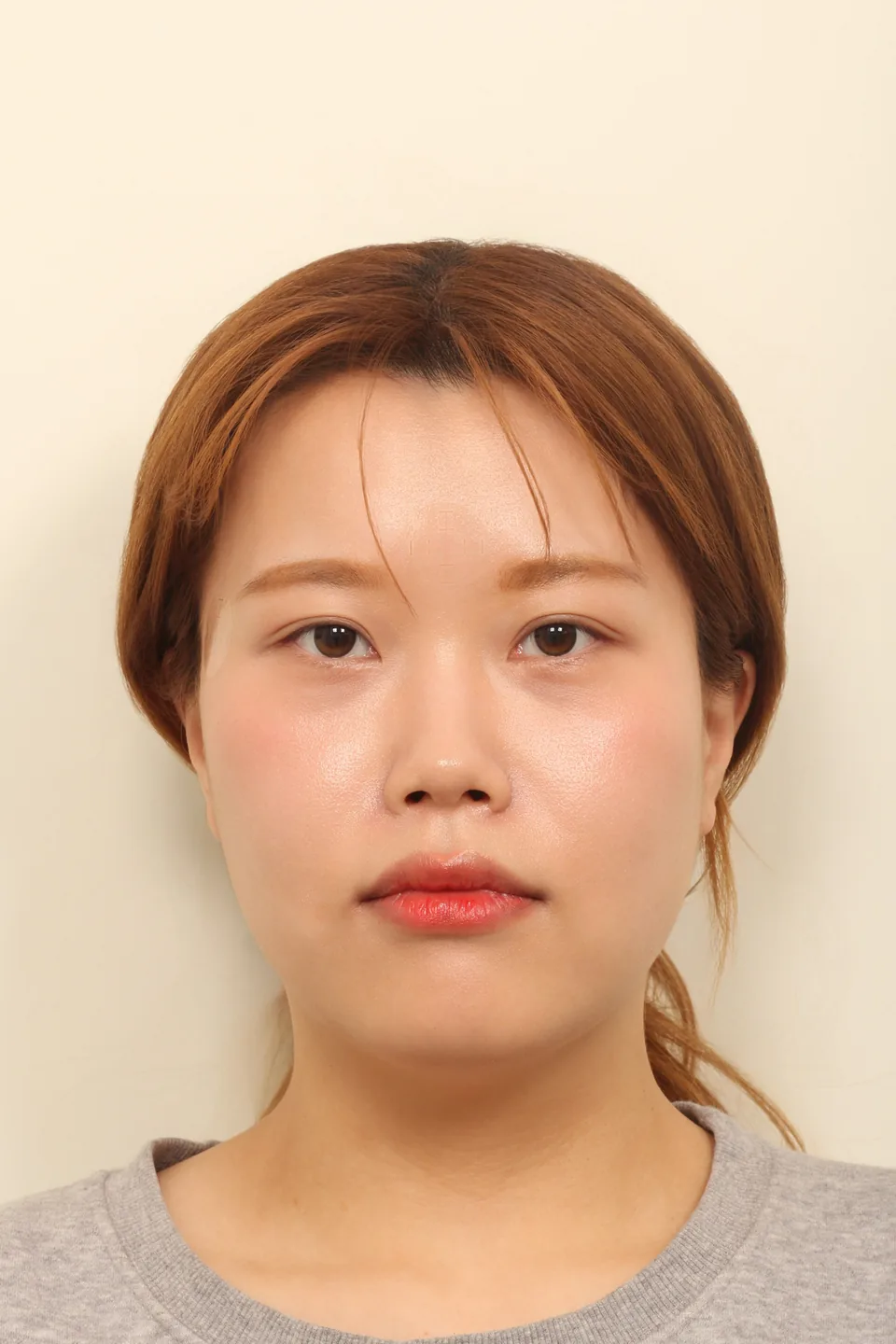 윤곽 3종 수술 전 정면