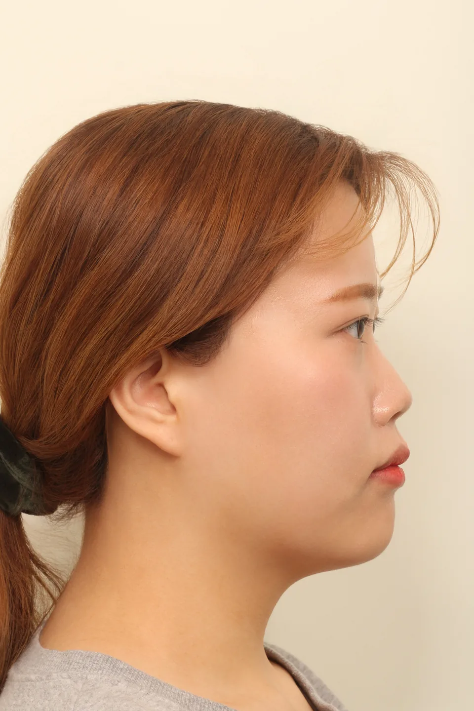 윤곽 3종 수술 전 측면