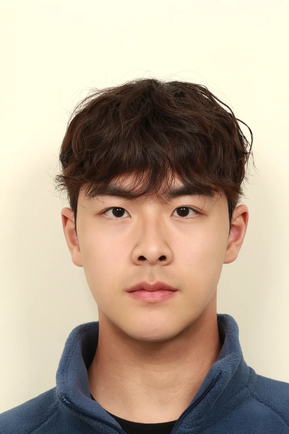 양악·윤곽 복합수술 후 6개월 정면