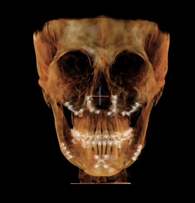 수술 후 CT (2026년 2월)