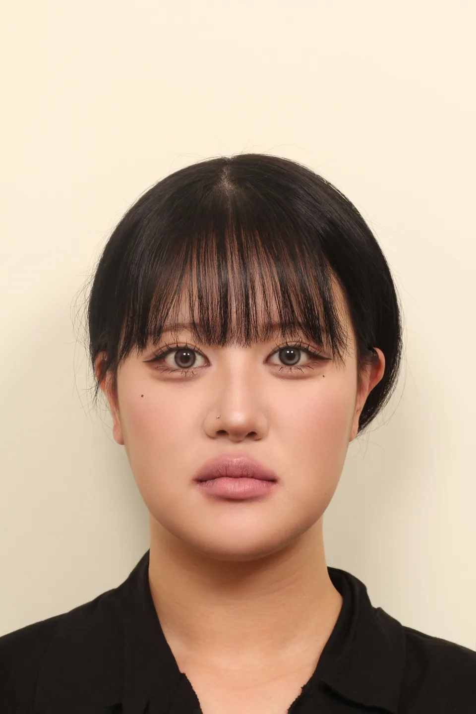 긴 얼굴 수술 후 6개월 정면