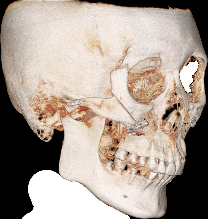 광대축소술 후 3D CT 뼈 모델