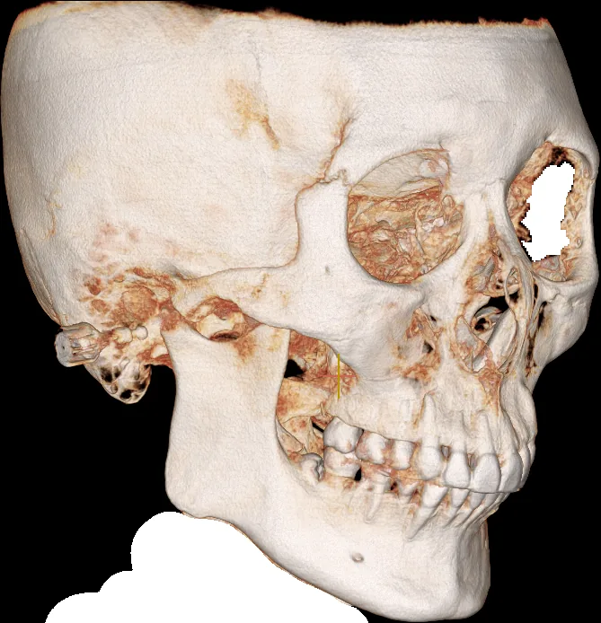 광대축소술 전 3D CT 뼈 모델