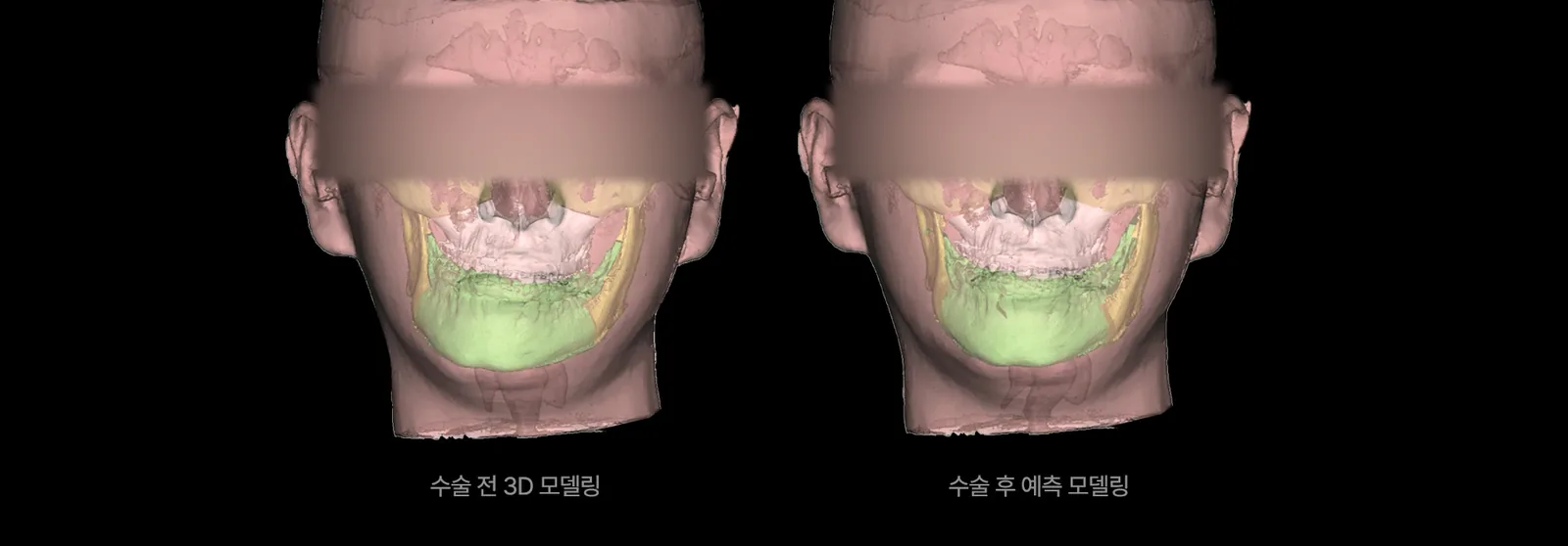 3D 가상수술 — 수술 전후 예측 비교