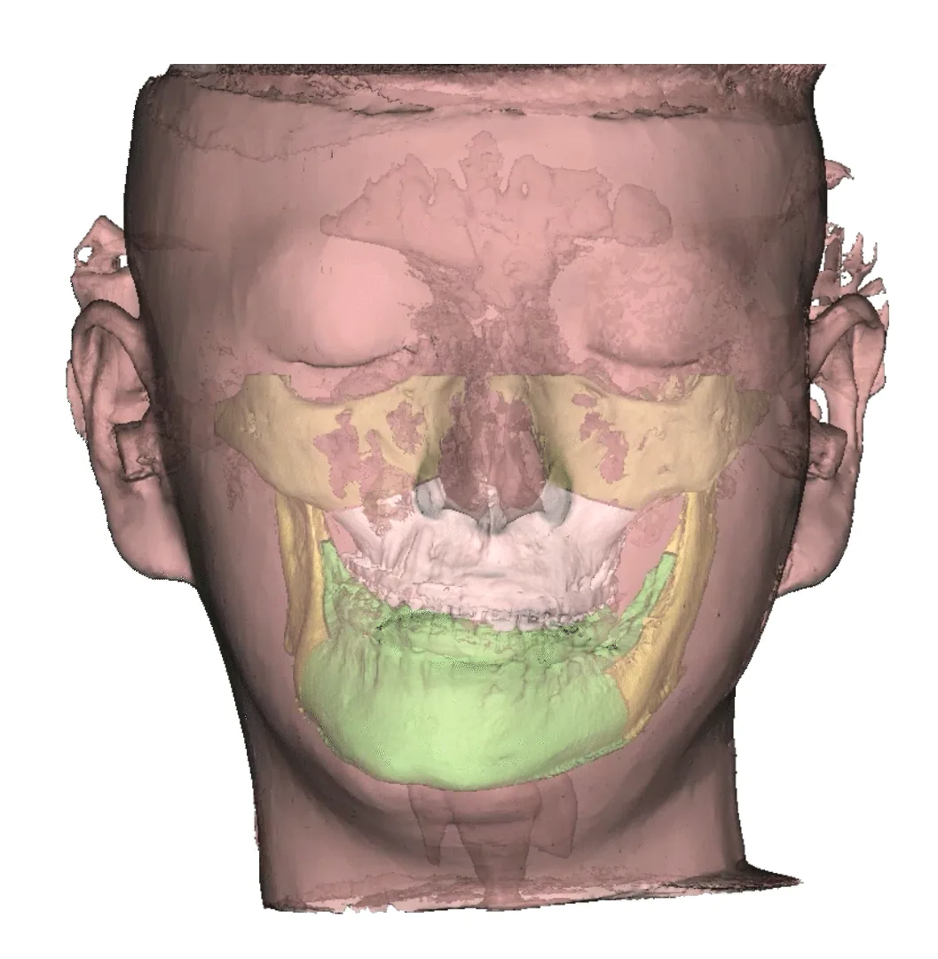 3D 가상수술 계획 화면