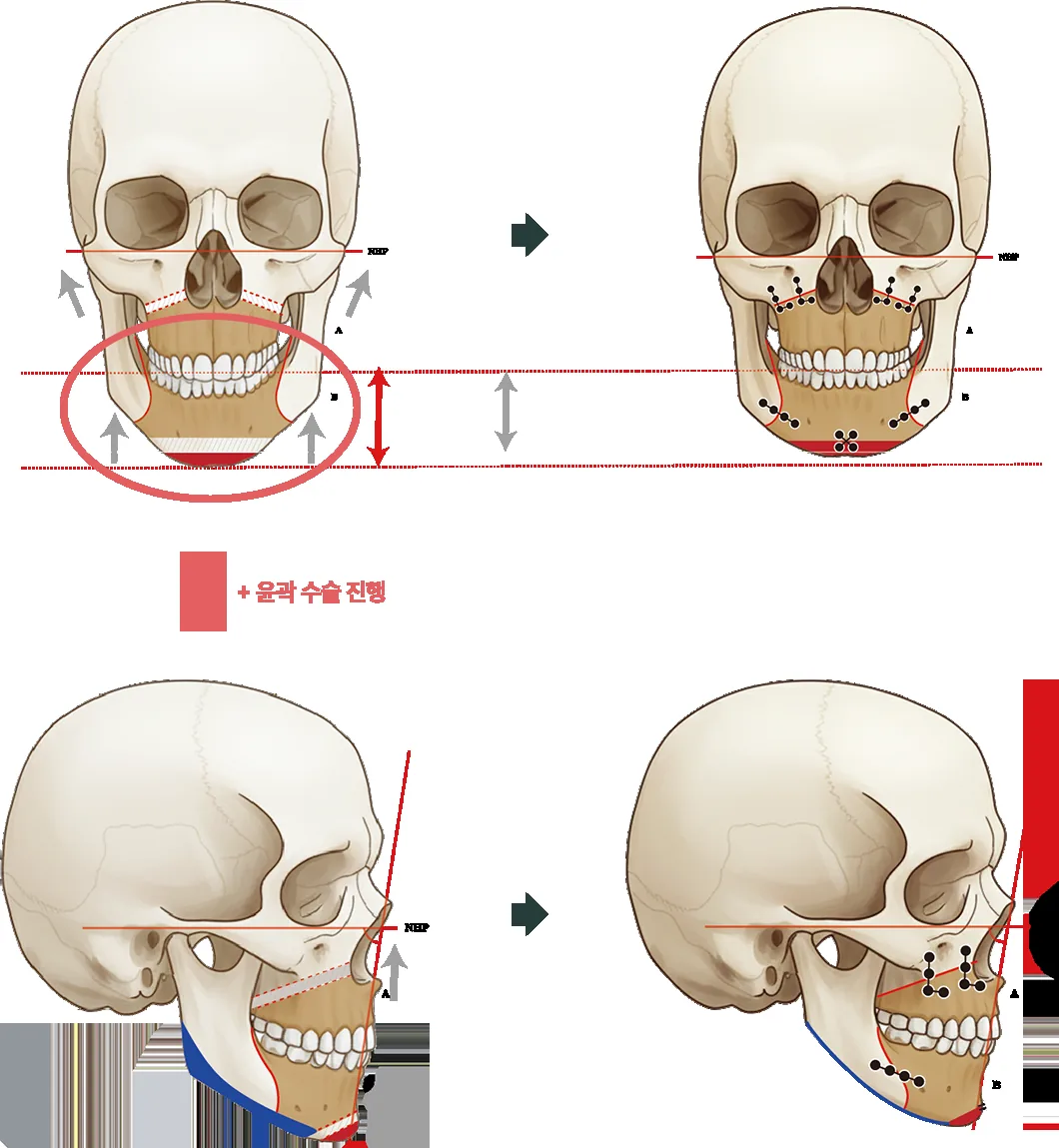 양악·윤곽 복합 수술 과정