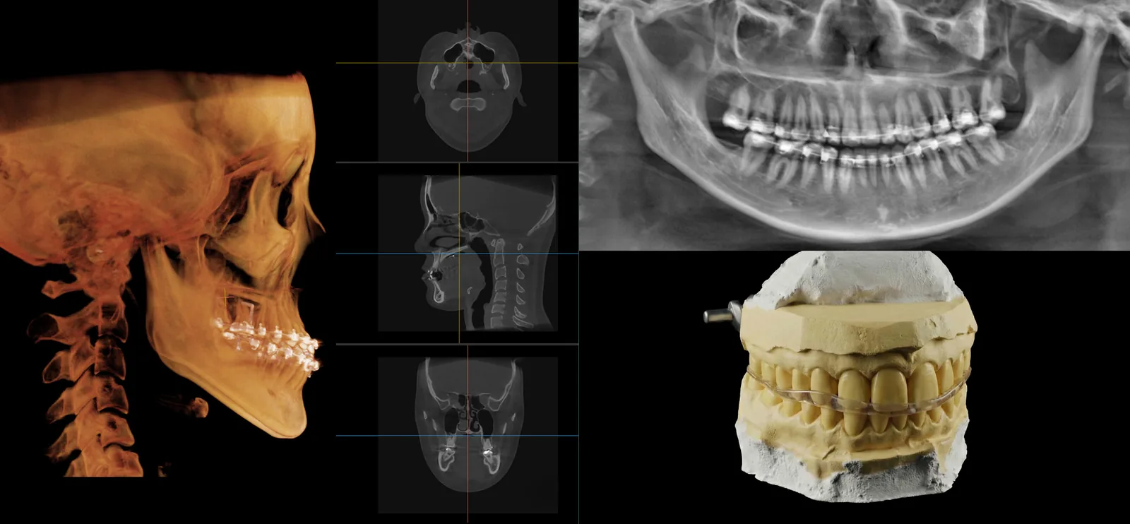 3D CT 분석 화면