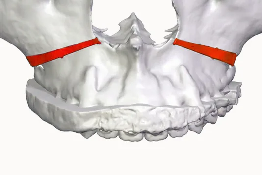3D 프린팅 가이드와 고정 계획