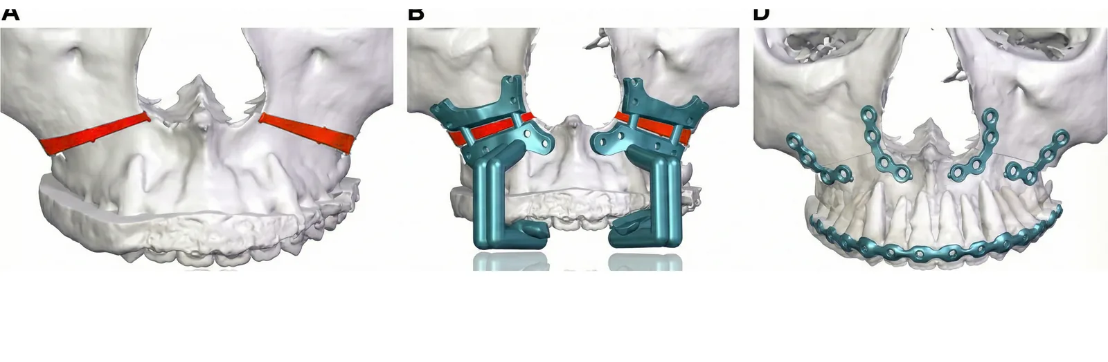 양악수술 고정 플레이트 3D 계획 화면